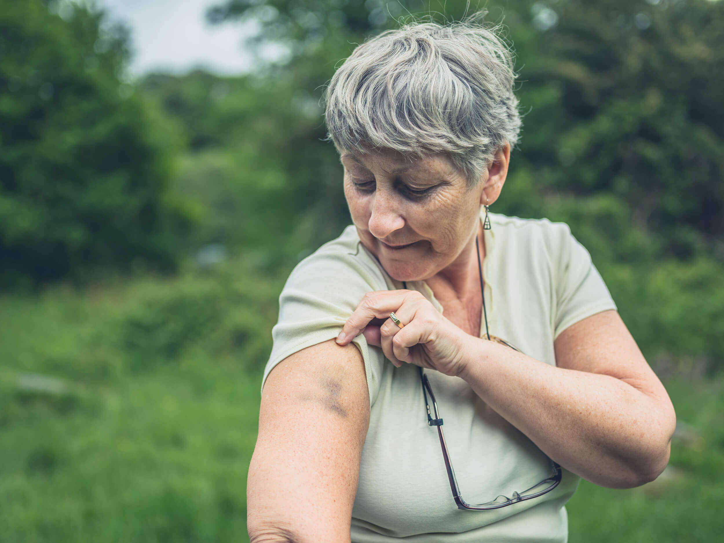 Skin Bruising in Elderly Adults: When Should I Worry?